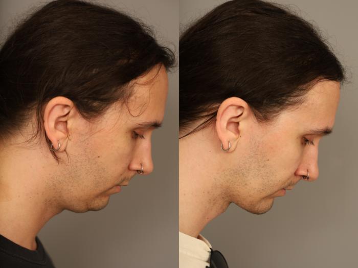 Before & After Mini Neck Lift (Single Incision) Case 333 Left Downward Gaze  View in New York, NY