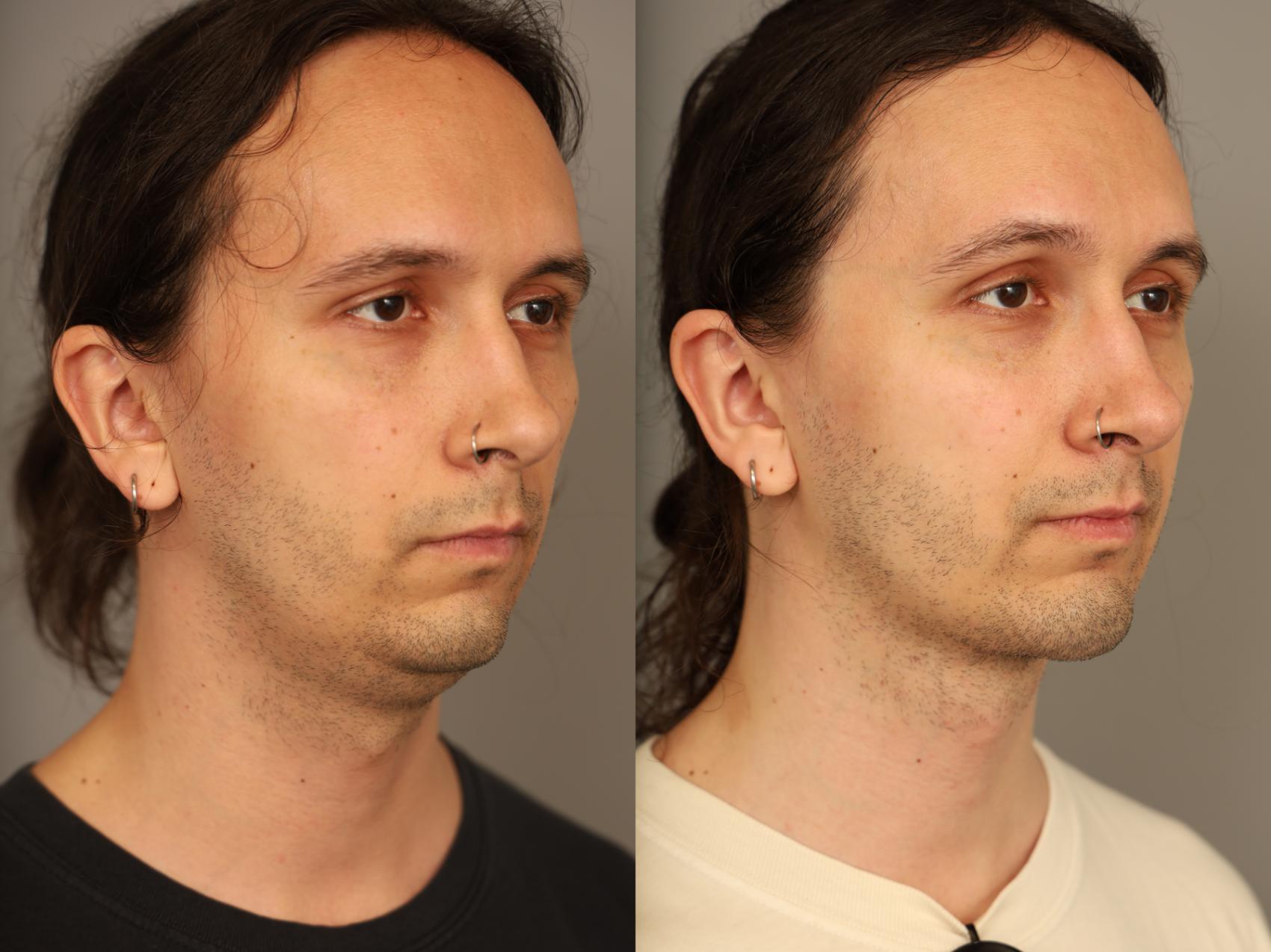 Before & After Mini Neck Lift (Single Incision) Case 333 Left Side View in New York, NY