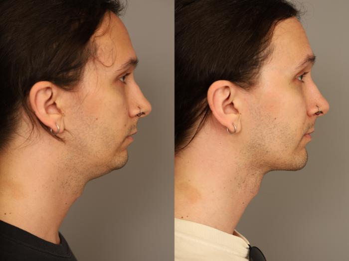 Before & After Mini Neck Lift (Single Incision) Case 333 Left Side Profile View in New York, NY