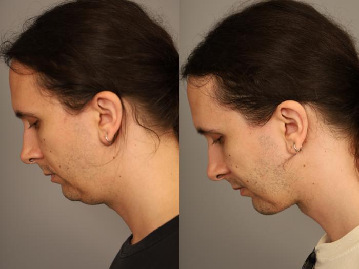 Before & After Mini Neck Lift (Single Incision) Case 333 Right Downward Gaze  View in New York, NY