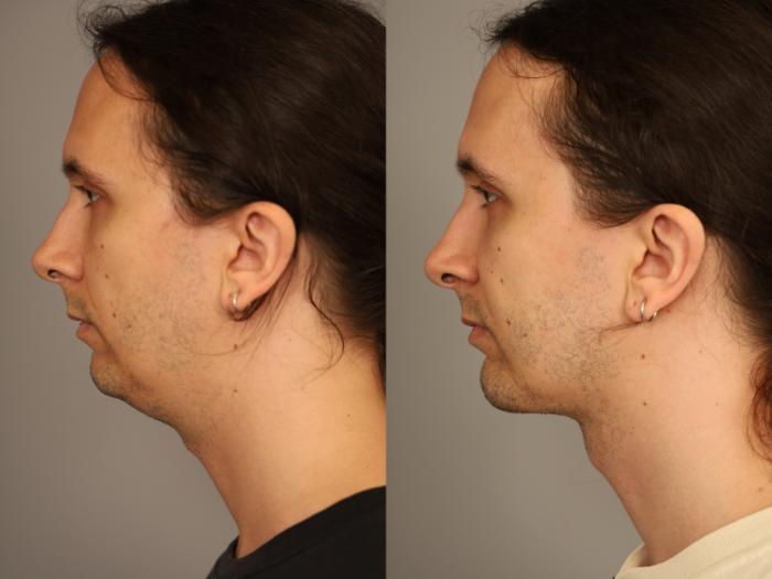 Before & After Mini Neck Lift (Single Incision) Case 333 Right Side Profile  View in New York, NY