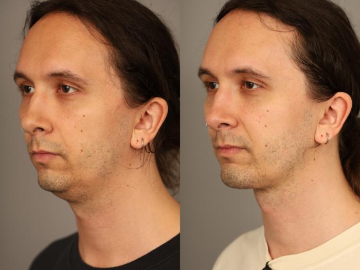 Before & After Mini Neck Lift (Single Incision) Case 333 Right Side View in New York, NY