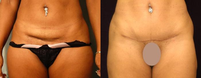 Mini Tummy-Tuck Straight After C-Section - Neaman Plastic Surgery
