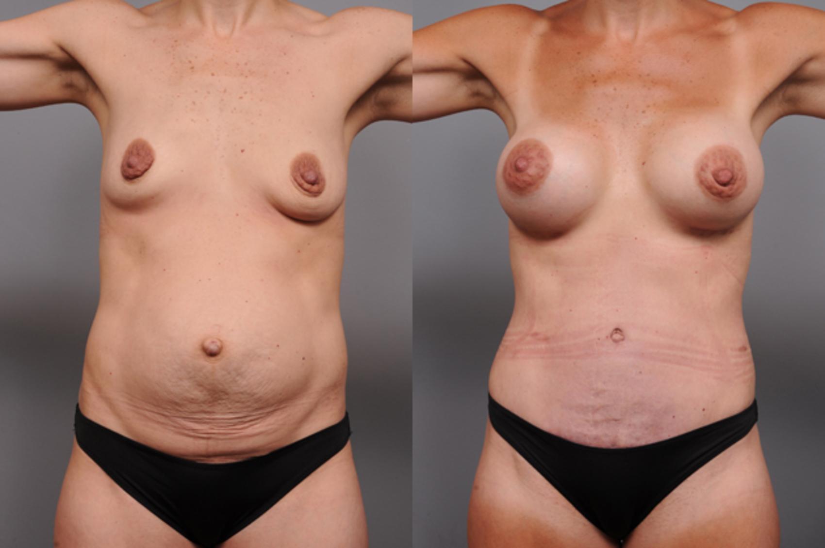 Before & After Mommy Makeover Case 191 View #2 View in New York, NY