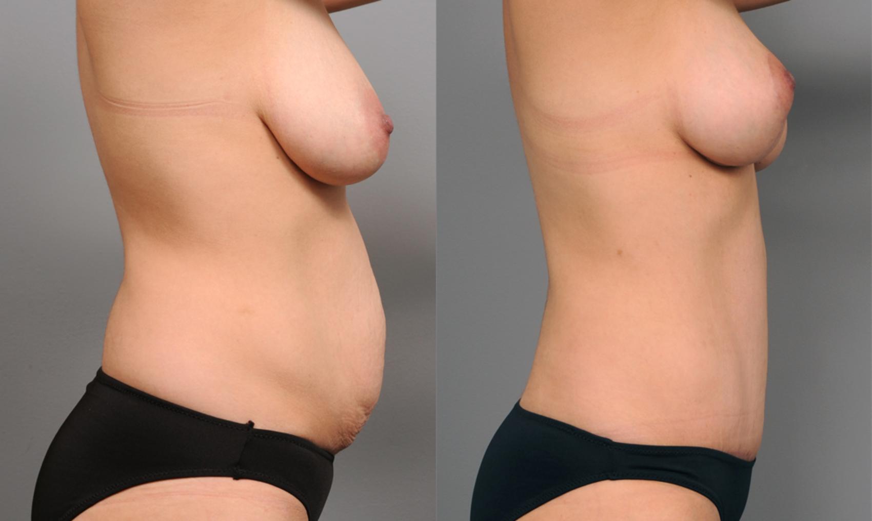 Tummy Tuck Candidates - NuBody Concepts