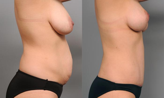 Before & After Tummy Tuck Case 195 View #1 View in New York, NY