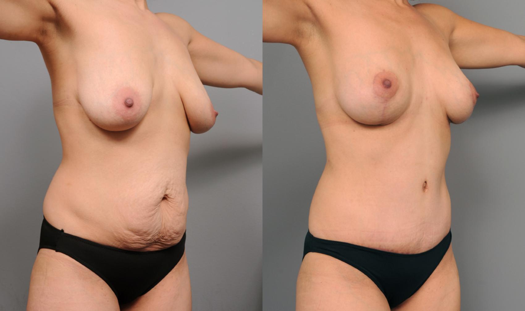 Before & After Mommy Makeover Case 195 View #2 View in New York, NY