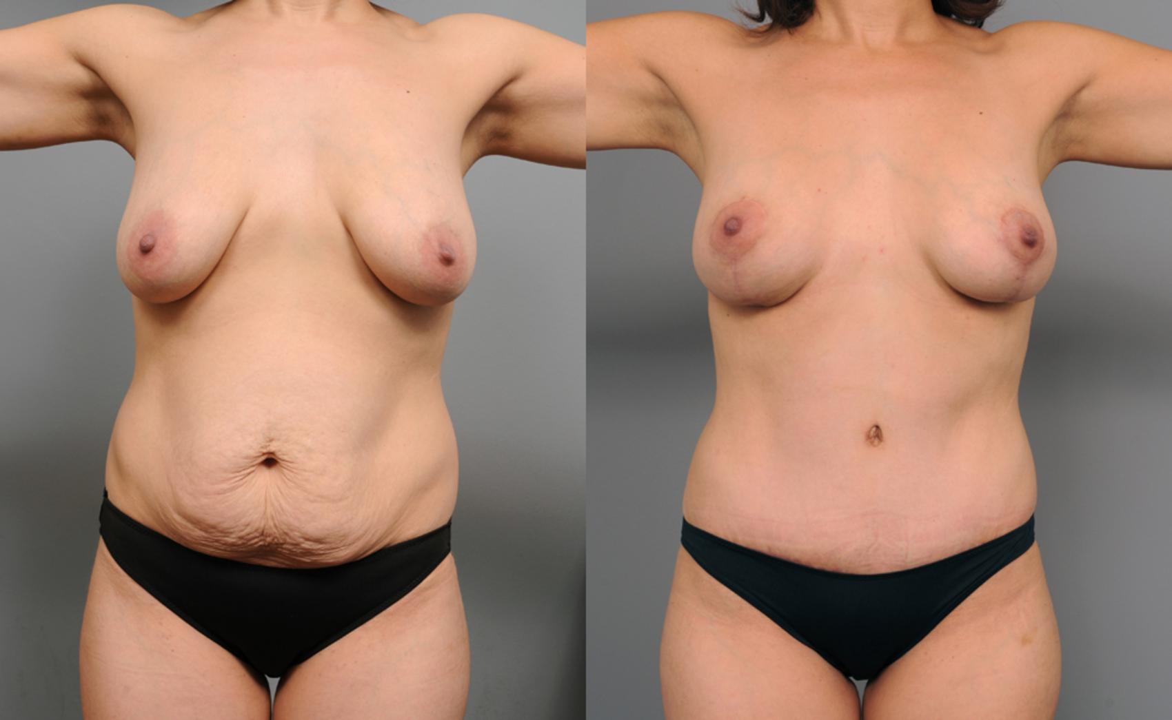 Before & After Mommy Makeover Case 195 View #3 View in New York, NY