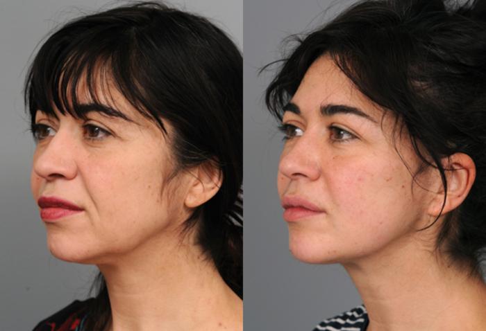 Before & After Naturalift™ Mini Facelift Case 211 View #1 View in New York, NY