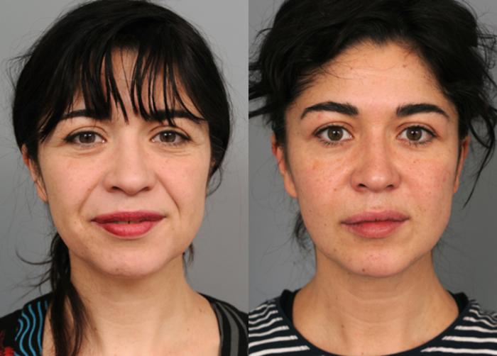 Before & After Naturalift™ Mini Facelift Case 211 View #2 View in New York, NY