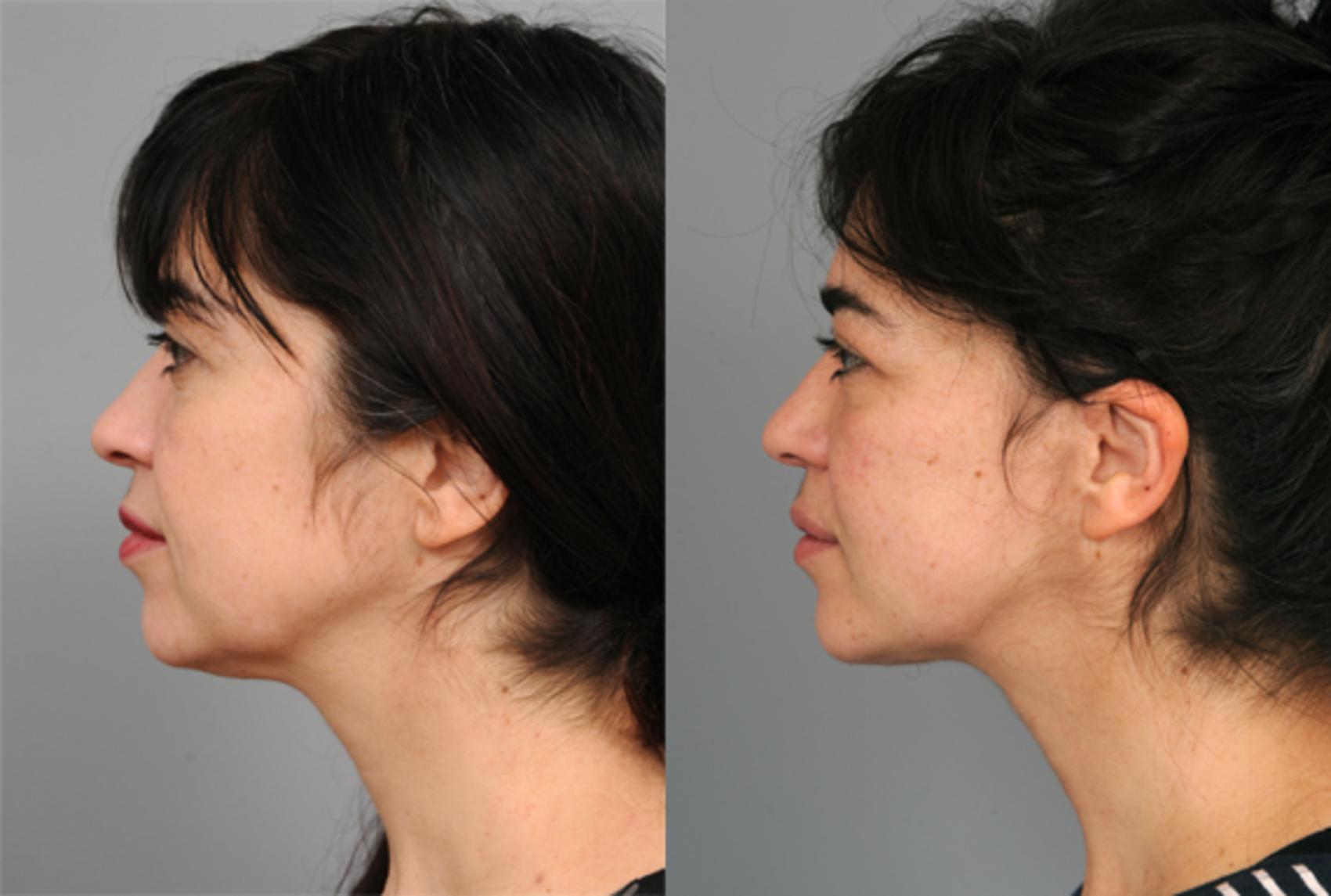 Before & After Naturalift™ Mini Facelift Case 211 View #3 View in New York, NY