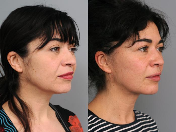 Before & After Naturalift™ Mini Facelift Case 211 View #4 View in New York, NY