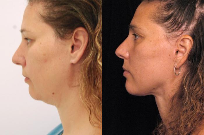 Naturalift℠ Mini Facelift Before & After Patient 77, NYC