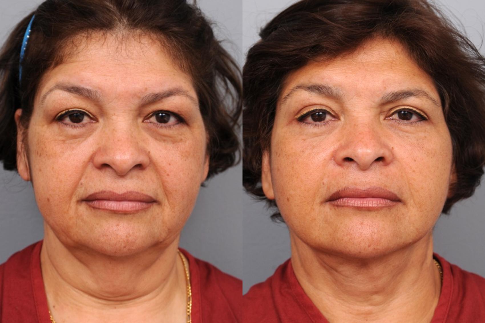 Before & After Naturalift™ Mini Facelift Case 79 View #1 View in New York, NY