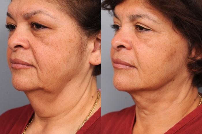 Before & After Naturalift™ Mini Facelift Case 79 View #2 View in New York, NY
