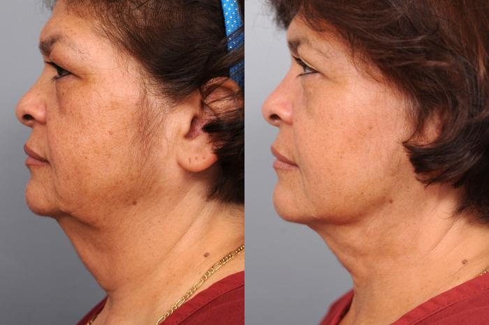 Before & After Naturalift™ Mini Facelift Case 79 View #3 View in New York, NY