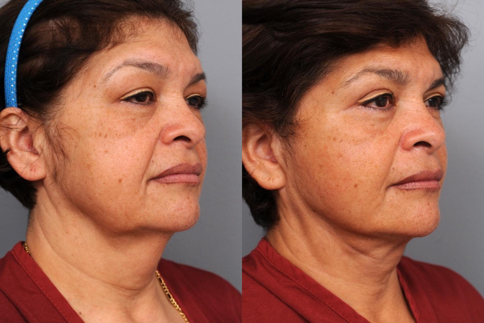 Naturalift℠ Mini Facelift Before & After Patient 79 NYC Dr. Thomas Sterry