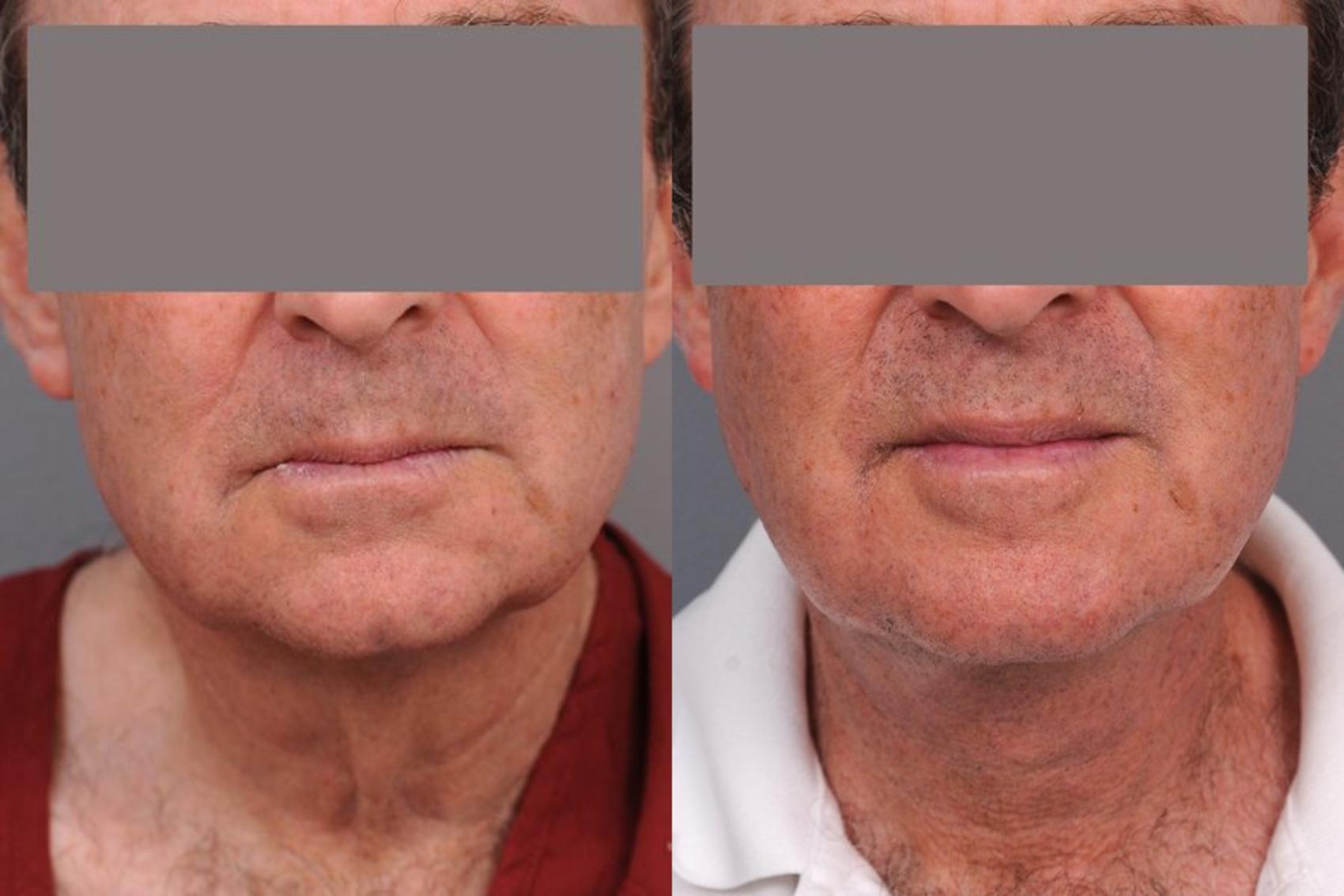 Before & After Neck Lift (Traditional) Case 76 View #1 View in New York, NY