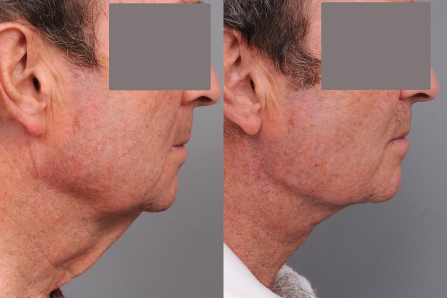 Before & After Neck Lift for Men Case 76 View #2 View in New York, NY