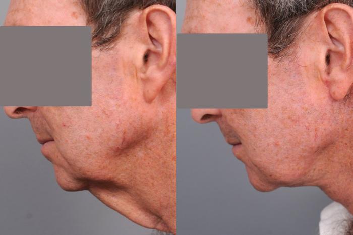 Before & After Neck Lift for Men Case 76 View #3 View in New York, NY