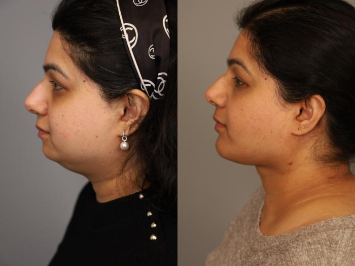 Before & After Neck Lift (Traditional) Case 293 Right Side View in New York, NY