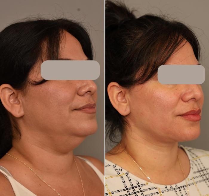 Before & After Neck Lift (Traditional) Case 305 Left Oblique View in New York, NY