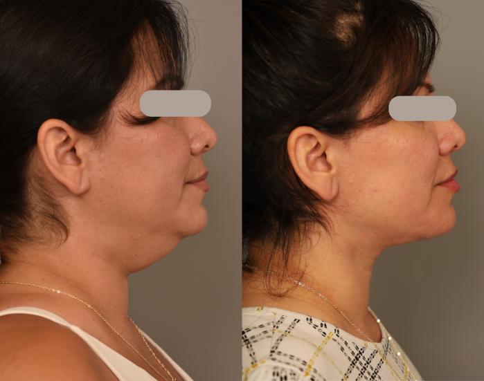 Before & After Neck Lift (Traditional) Case 305 Left Side View in New York, NY