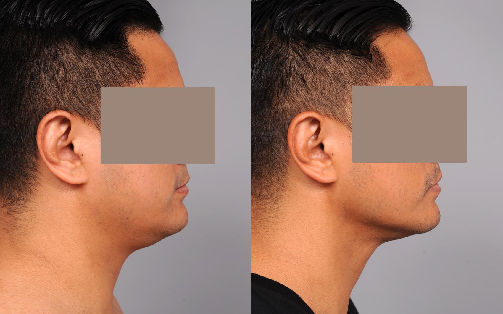 Neck Liposuction For Men Before And After Photo Gallery New York Ny Thomas P Sterry Md