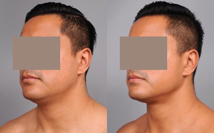 Before & After Neck Liposuction / Chin Liposuction  Case 183 View #2 View in New York, NY