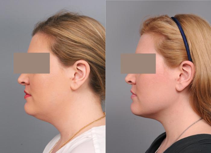 Before & After Neck Liposuction / Chin Liposuction  Case 184 View #1 View in New York, NY
