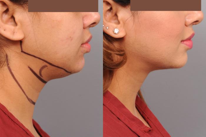 Before & After Neck Liposuction / Chin Liposuction  Case 185 View #1 View in New York, NY