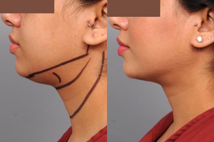 Before & After Neck Liposuction / Chin Liposuction  Case 185 View #2 View in New York, NY