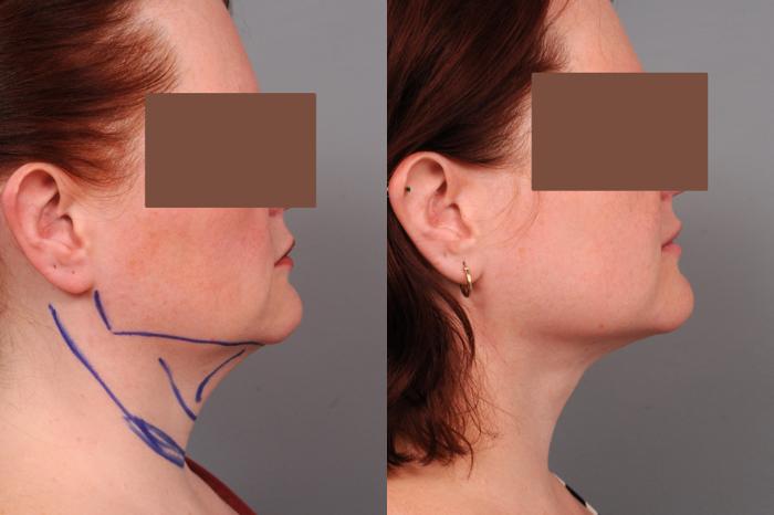 Before & After Neck Liposuction / Chin Liposuction  Case 188 View #1 View in New York, NY
