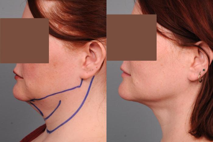 Before & After Neck Liposuction / Chin Liposuction  Case 188 View #2 View in New York, NY