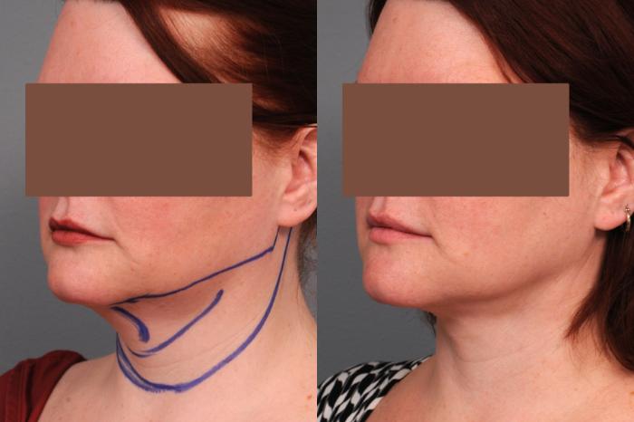 Before & After Neck Liposuction / Chin Liposuction  Case 188 View #3 View in New York, NY