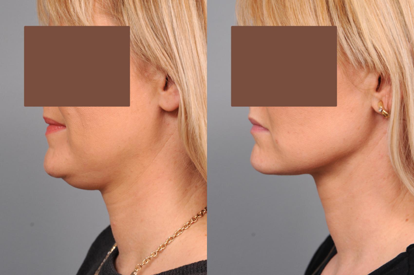 Placement of Facial Compression Garment Marena Facelift Chin Liposuction  Kybella, Board Certified Plastic Surgeon Located In Newport Beach, CA