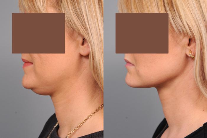 Before & After Neck Liposuction / Chin Liposuction  Case 189 View #1 View in New York, NY