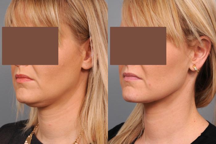 Before & After Neck Liposuction / Chin Liposuction  Case 189 View #2 View in New York, NY