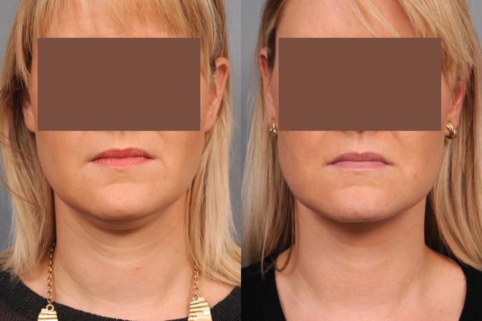Before & After Neck Liposuction / Chin Liposuction  Case 189 View #3 View in New York, NY