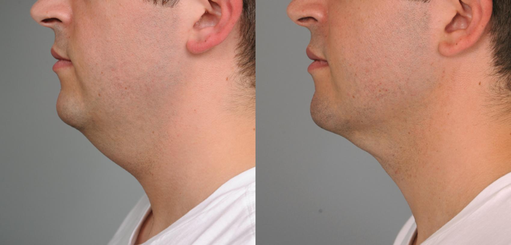 Before & After Neck Liposuction / Chin Liposuction  Case 192 View #1 View in New York, NY