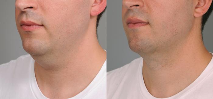 Before & After Neck Liposuction / Chin Liposuction  Case 192 View #2 View in New York, NY
