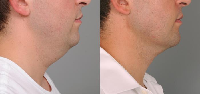 Before & After Neck Liposuction / Chin Liposuction  Case 192 View #3 View in New York, NY