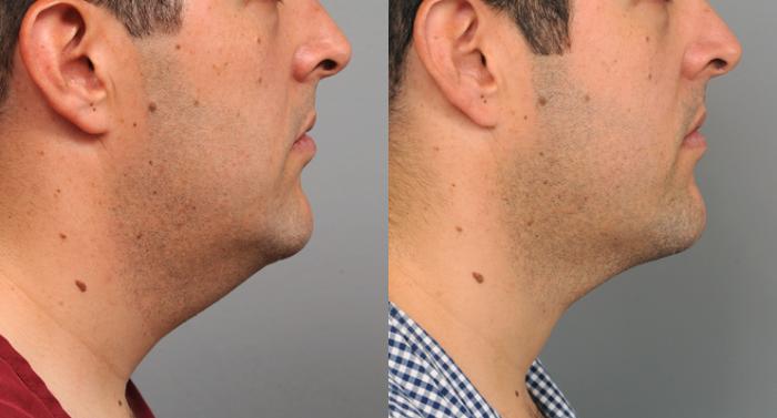 Neck Liposuction for Men Before and After Photo Gallery