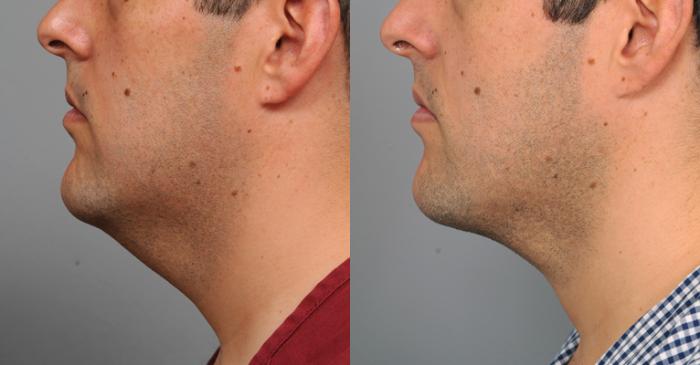 Before & After Neck Liposuction / Chin Liposuction  Case 196 View #2 View in New York, NY