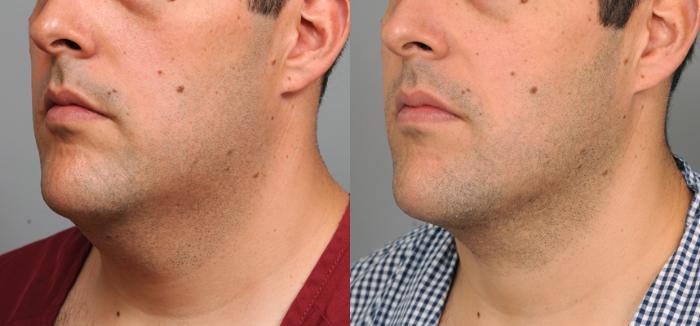 Before & After Neck Liposuction / Chin Liposuction  Case 196 View #3 View in New York, NY