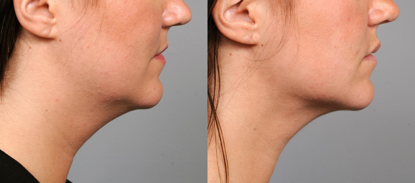 Before & After Neck Liposuction / Chin Liposuction  Case 201 View #1 View in New York, NY