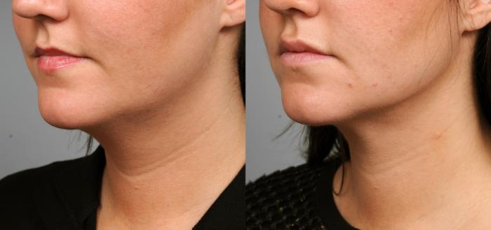Before & After Neck Liposuction / Chin Liposuction  Case 201 View #2 View in New York, NY