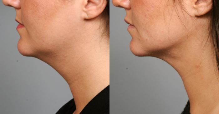 Before & After Neck Liposuction / Chin Liposuction  Case 201 View #3 View in New York, NY