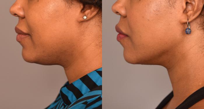 Before & After Neck Liposuction / Chin Liposuction  Case 226 View #1 View in New York, NY