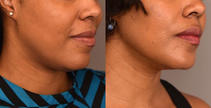 Before & After Neck Liposuction / Chin Liposuction  Case 226 View #2 View in New York, NY